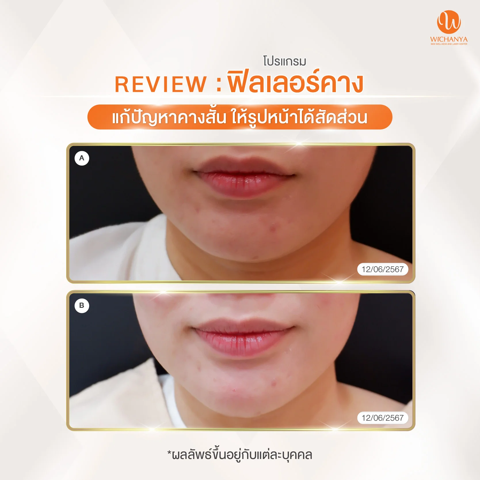 รีวิวฉีดฟิลเลอร์คาง