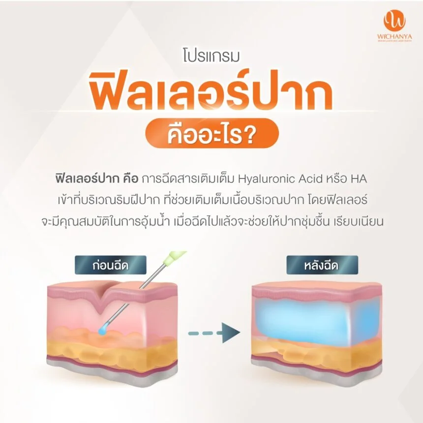 ฟิลเลอร์ปาก คืออะไร