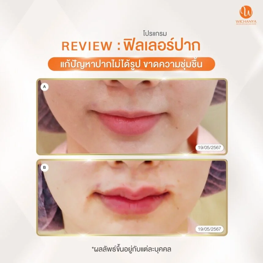 รีวิวฟิลเลอร์ปาก