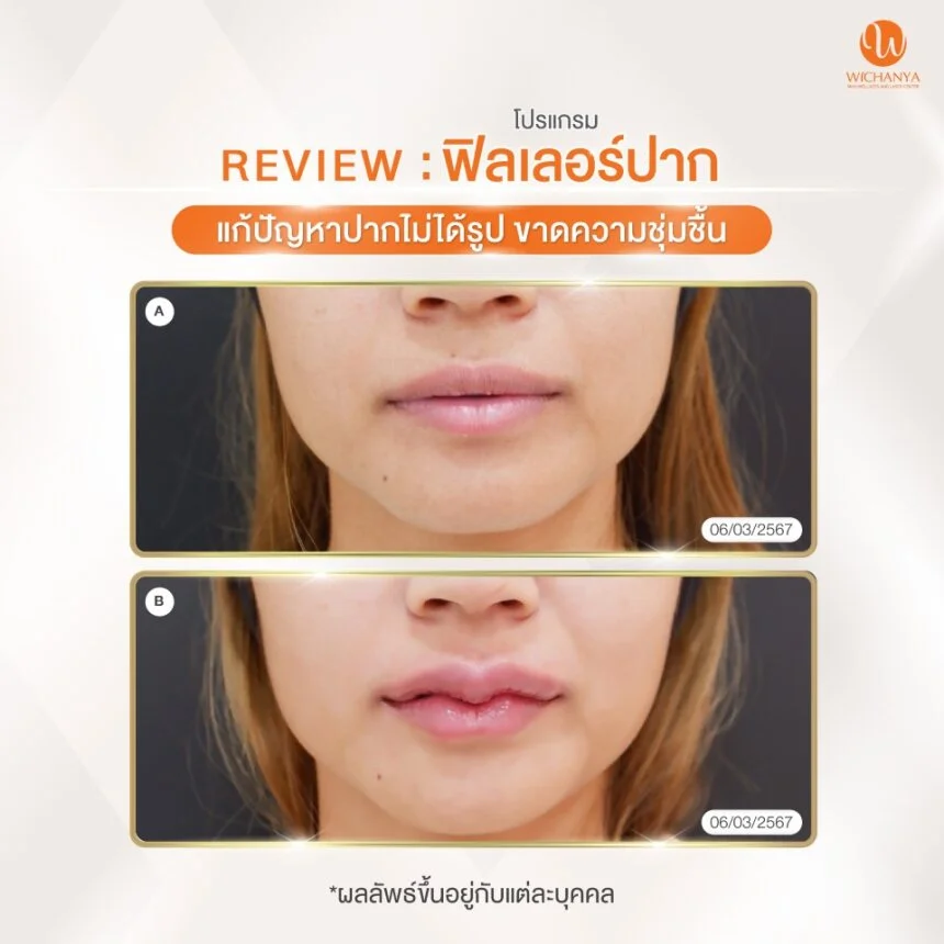 รีวิวฟิลเลอร์ปาก