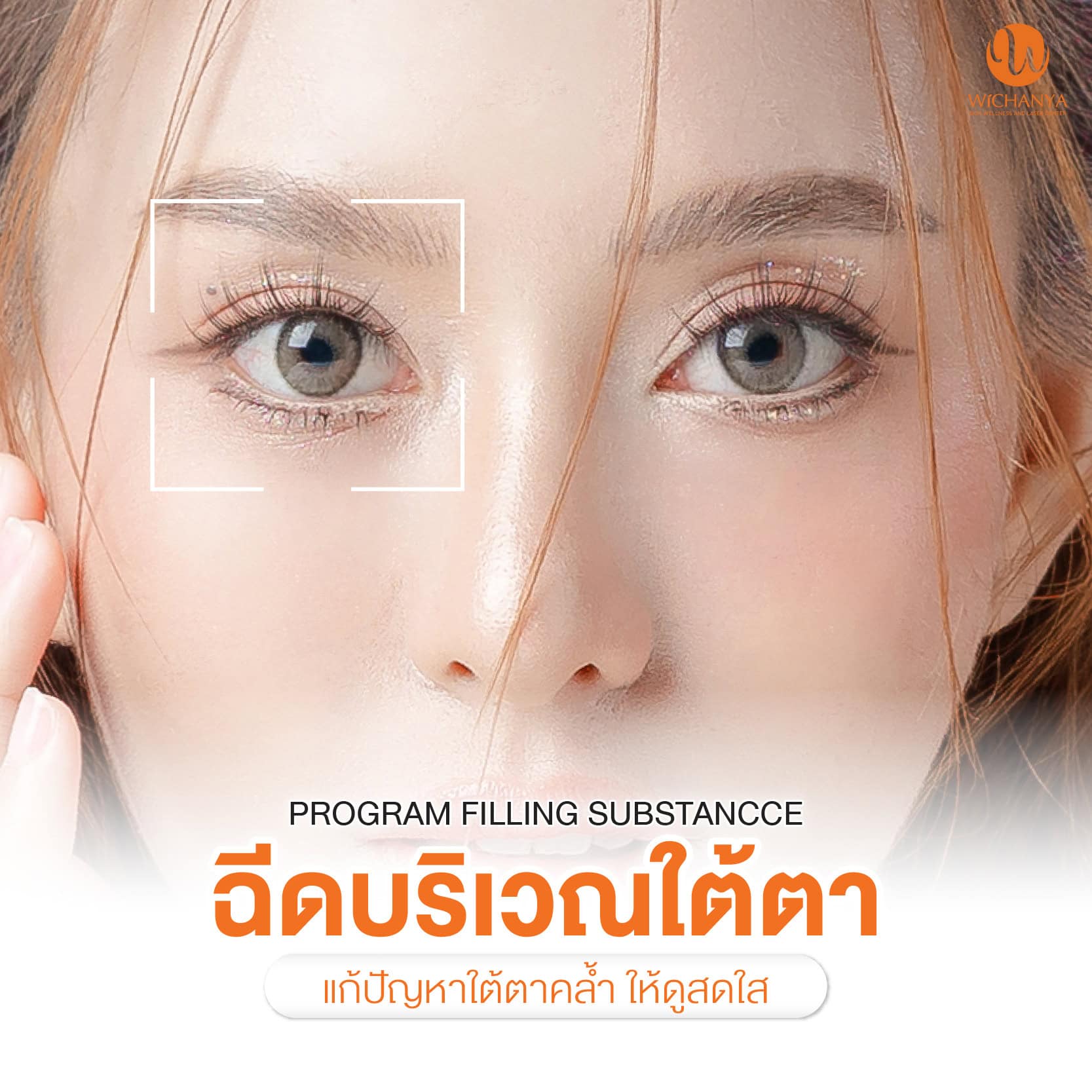 ฉีดฟิลเลอร์ใต้ตา Filler